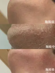 メンズ全身脱毛(顔・VIO込み)