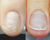 【深爪の緩和、自爪育成モデル】（初回価格）限定3名様