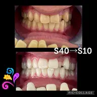 【お客様ご要望】一回でかなり白くしたい‼︎9分✖️5回セット