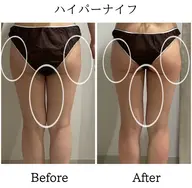 下半身痩せ🔥パンツ・スカートが映える脚に👗短時間でスッキリ!¥25,300→¥6,600