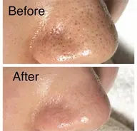 【ご新規様】ごっそり毛穴洗浄ハイドロスプラッシュ 1回¥9,500→¥5,000