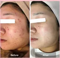 🌿ハーブピーリングノーマル＆(毛穴洗浄、角質除去、美容保湿)🌿吹き出物、吹き出物跡、毛穴、美白、黒ずみ、肌質ケアに