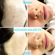 【肌荒れ・ニキビ】ビタミンC導入×美容鍼