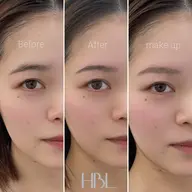 HBL…(ハリウッドブロウリフト)