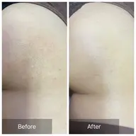 【お尻or背中上部】ハーブピーリング