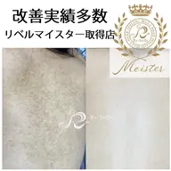 【剥離あり/ニキビケア毛孔性】リベルハーブピーリング背中上（2000円券付）90分