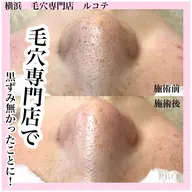 \毛穴スッキリコース/毛穴エクストラクションで黒ずみざらつきを一度でリセット！