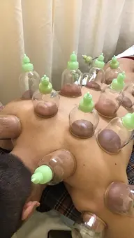 カッピング療法!アスリートが大注目!(所要時間60~80分かかる場合があります。)