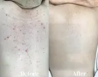 痛みなし！ダウンタイムなし！背中ピーリング❣️
