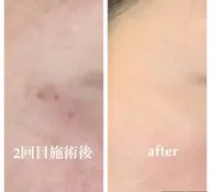 美白効果◎3月限定シミケア⚡️施術練習モデル