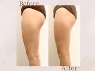 【ミニモ限定価格★モニター美脚痩身】キャビテーション×EMS ¥22,000→10,000