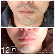 フェイシャル脱毛　大好評大人気IPL脱毛⭐️痛みに弱くても、しっかりムダ毛に反応⭐️近隣最安値でエステ脱毛の最高級を🎵