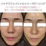 【初回体験】徹底毛穴!ツルピカ水光肌✨ハイドラフェイシャル&ハーブピーリング🌿