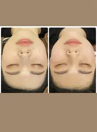 結果重視❗️5名様限定特典💆‍♀️💗小顔ケア4000ショット‼️特別価格にて🥰