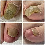 無料モデル募集！変形爪、肥厚爪、タコ、魚の目4月17日、24日限定