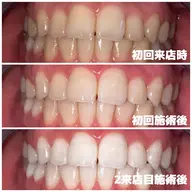 【 白さを極める・2来店で集中ケア 】🔹高濃度プレミアムホワイトニング〈 2来店合計70分照射 〉🔹