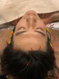 🔥人気急上昇メニュー🔥メンズ美容鍼🪡