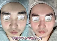 【毛穴レスと小顔同時に実現】毛穴ディープ洗浄×小顔リフトリンパマッサージ、メンズもおすすめ