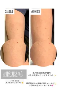 腕脱毛(指先、脇込)¥7000→¥6000