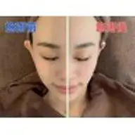 大人気！最先端【FOCUS NEO】むくみ解消小顔リフトアップ全顔コース+¥2,000で目元集中コースに変更可能です！