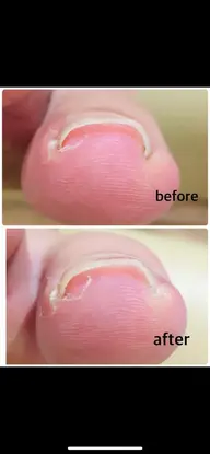 巻き爪ケア(1本)
