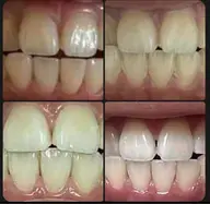 🦷セルフホワイトニング