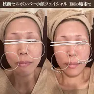 【DNA美容】内側からふっくら✨艶肌リフトアップフェイシャル 核酸セルボンバークリーム使用(60分)