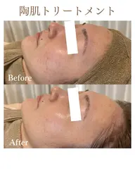 【初回お試し】REVIハーブピーリング🌿