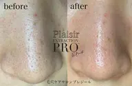 毛穴ケア集中コース☆SNSで話題の毛穴エクストラクションプロでツルツル毛穴美人❤️