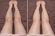 【都度払い】部分脱毛 Lパーツ１ヶ所　￥4,000