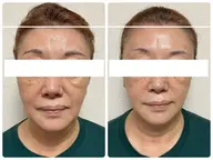 【エイジングケア】最強リフトアップトリートメント❤️当店人気No.1のフェイシャルメニュー