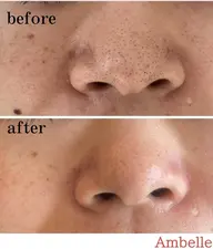 【毛穴特化コース】または、【吹き出物特化コース】