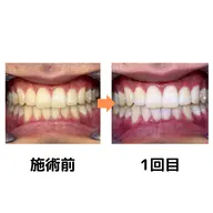 【minimo限定】輝く白い歯へ セルフホワイトニング 1回目からトーンアップ 初回¥2,480