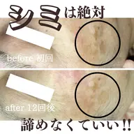 【最新の次世代シミケア】20ショット