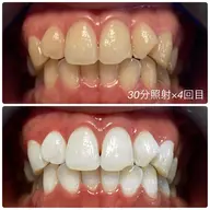 【特別お試しプラン】セルフホワイトニング 30分照射 × 3回チケット