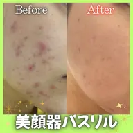 【パスリル購入希望者限定】新美顔器パスリルリュクス体験✨たった5分で-3㎏小顔・美肌に導く美顔器🕊️