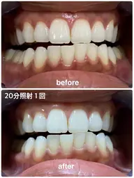 【歯の黄ばみ】白くするホワイトニング40分コース