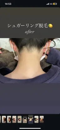 うなじ脱毛✨
