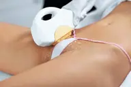 【美容VIO脱毛】エステ以上の圧倒的な抜けと美肌！毛の復活も無く粘膜まで脱毛