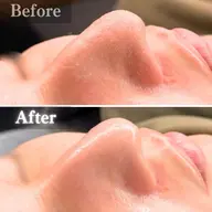 【人気No.1🔥角栓汚れゴッソリ】全顔毛穴洗浄 × 高濃度ビタミンC浸透ケア◎ニキビやいちご鼻でお悩みの方にも