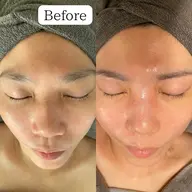 【シワ、ハリにはコレ】たるみ改善🫧炭酸コース