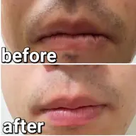 メンズ 鼻下あご脱毛 初回来店限定価格50%OFF