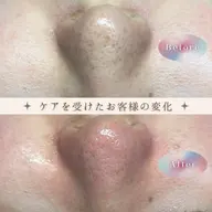 毛穴エクストラクション🍓