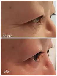 【むくみ】フェイシャル　ハーブピーリング