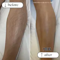 【men's脱毛】脚　¥5000(通常¥7000)