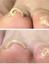 巻き爪ケア導入キャンペーン