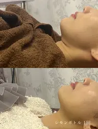 【初回特別価格‼️】脂肪細胞アプローチ🍋小顔施術でリバウンドなし🙆‍♀️✨