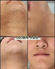 痛くない！キャンペーン50%OFF【U23限定】メンズフェイシャル脱毛　30分　¥4,400→￥2,200 回数１回