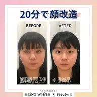☆速攻美肌＆リフトUP☆ポレーション美容導入+小顔EMS