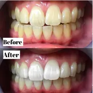 【⚜️チケット会員様⚜️】専用メニュー🦷✨ハイパワー4回照射